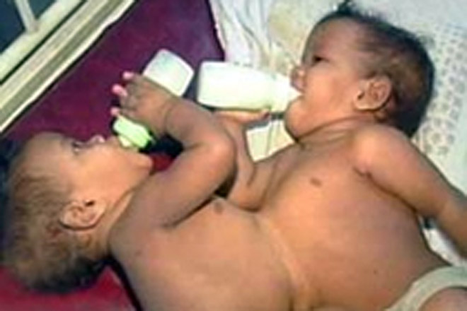 В Индии разделили сиамских близнецов