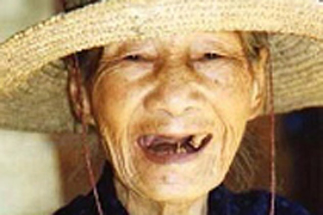 Потеря зубов в старости связана со слабоумием