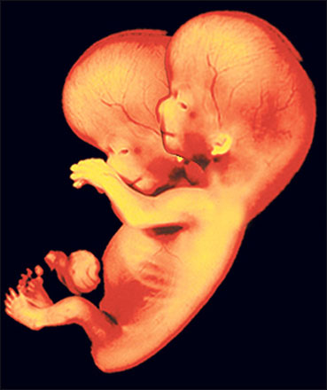 Британка, беременная двухголовым ребенком, отказалась от аборта