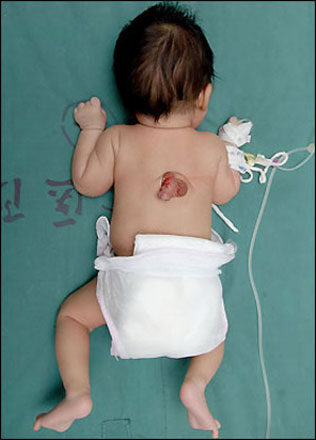 В Китае родился ребенок с половым органом на спине