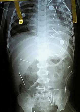 Бразильские врачи нашли в теле двухлетнего мальчика 50 иголок