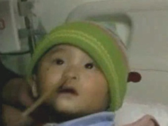 Хирурги извлекли из черепа годовалого младенца палочку для еды