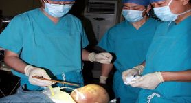 Хирурги извлекли из черепа годовалого младенца палочку для еды