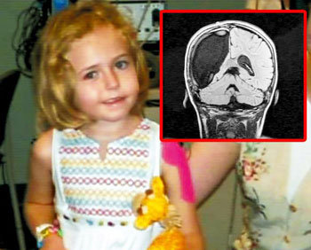 9-летней девочке из Бостона удалили половину мозга
