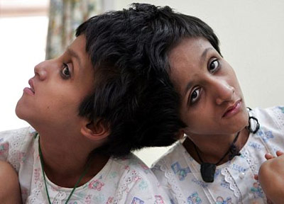 Эвтаназия! Отец сиамских близнецов умоляет избавить от мучений 15-летних девочек (фотосессия)