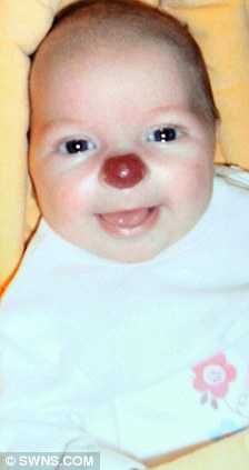 Девочка родилась с красным клоунским носом (фотосессия)