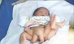 Pakistanda 6 ayaqlı uşaq doğulub (FOTO)
