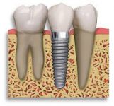 Dental implantasiya (FOTO)