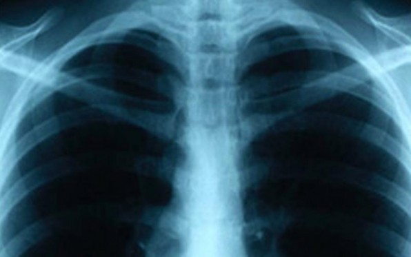 В Турции снижается численность больных туберкулезом