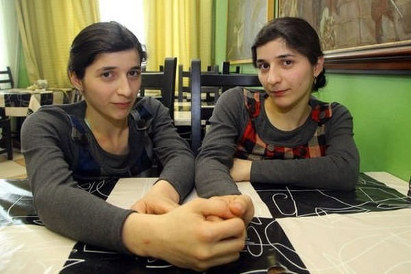 Одна из сиамских близнецов Зита Резаханова умерла в Кыргызстане