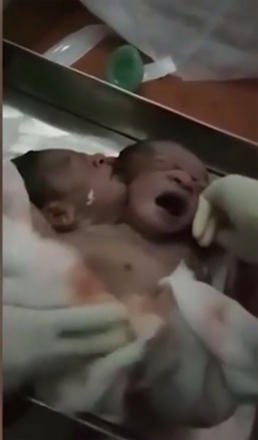 Hindistanda ikibaşlı uşaq doğulub (VİDEO)