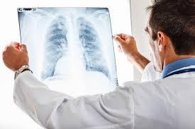 Ежедневно в мире от туберкулеза умирают до 5 тыс. человек