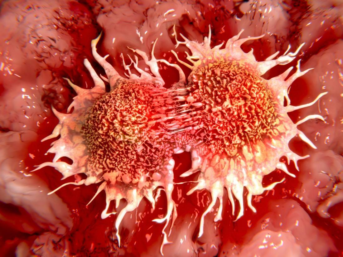 Ученые нашли способ предотвратить смертельную стадию рака