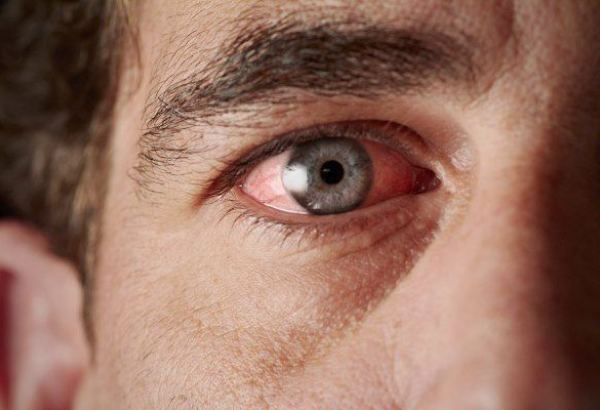 Göz zədələnməsinə səbəb olan allergik xəstəliklərin SƏBƏBİ açıqlandı