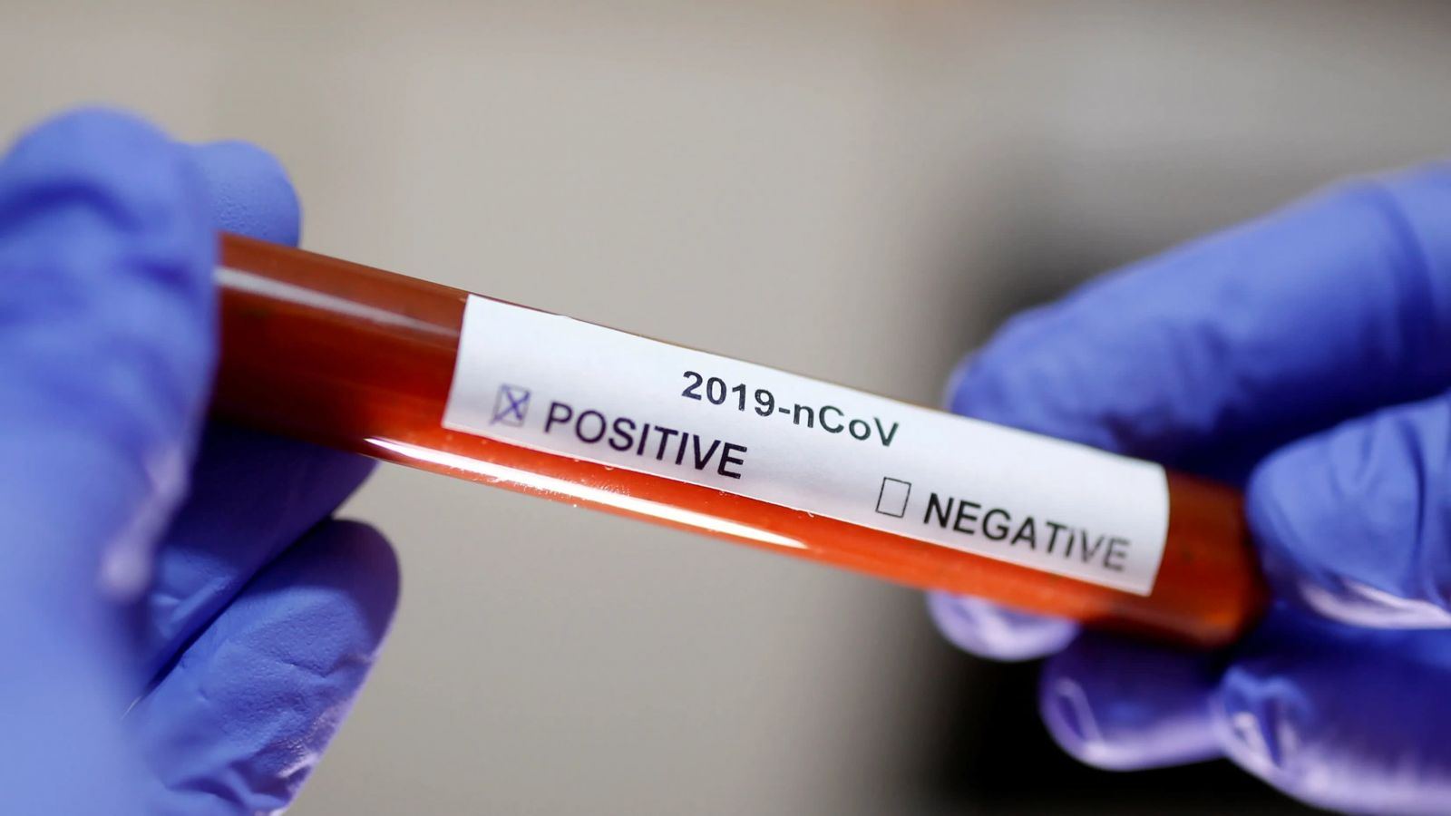 Argentinada koronavirusa rekord sayda yoluxma halı qeydə alınıb