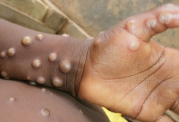 First case of monkeypox detected in Texas resident
