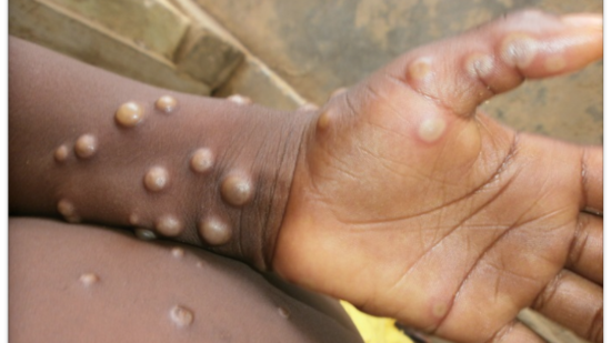First case of monkeypox detected in Texas resident