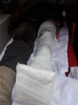 Health status of Azerbaijani Tartar resident injured by mine blast revealed (PHOTO)